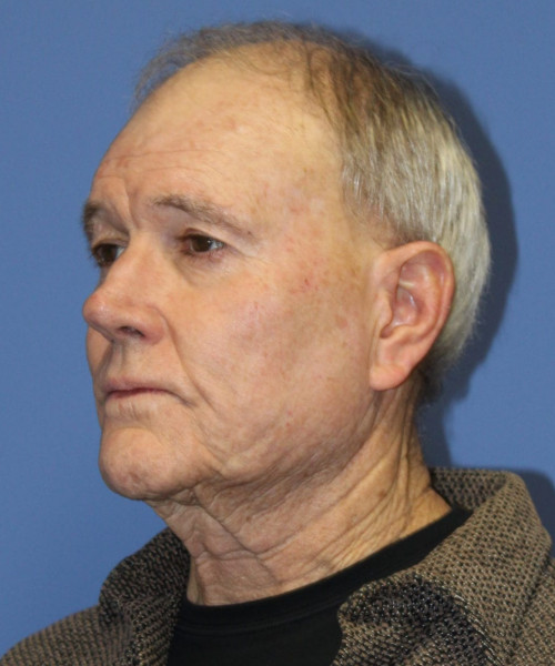 Facelift # 5959 – click HERE for more views before photo. Individual results may vary.