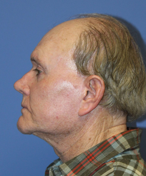 Facelift # 5959 – click HERE for more views after photo. Individual results may vary.