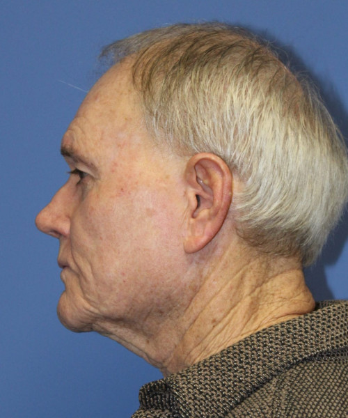 Facelift # 5959 – click HERE for more views before photo. Individual results may vary.