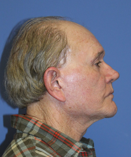 Facelift # 5959 – click HERE for more views after photo. Individual results may vary.