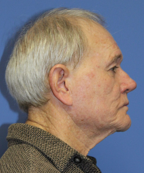 Facelift # 5959 – click HERE for more views before photo. Individual results may vary.