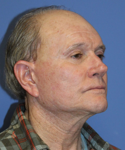 Facelift # 5959 – click HERE for more views after photo. Individual results may vary.