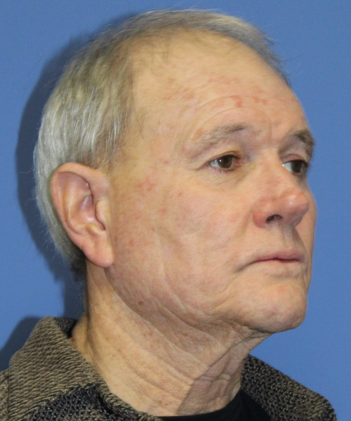 Facelift # 5959 – click HERE for more views before photo. Individual results may vary.