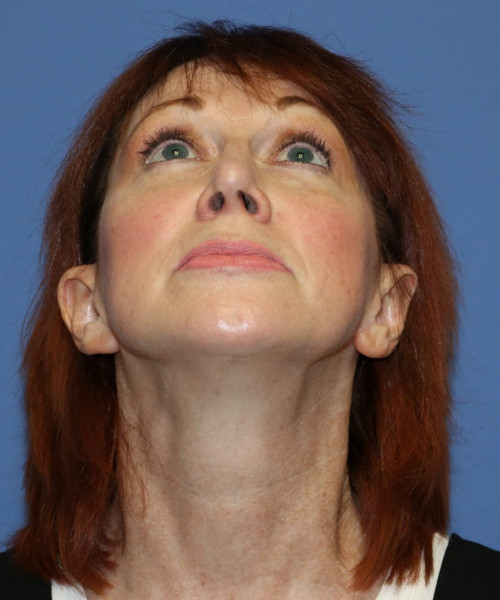 Facelift #5986 – click HERE for more views after photo. Individual results may vary.