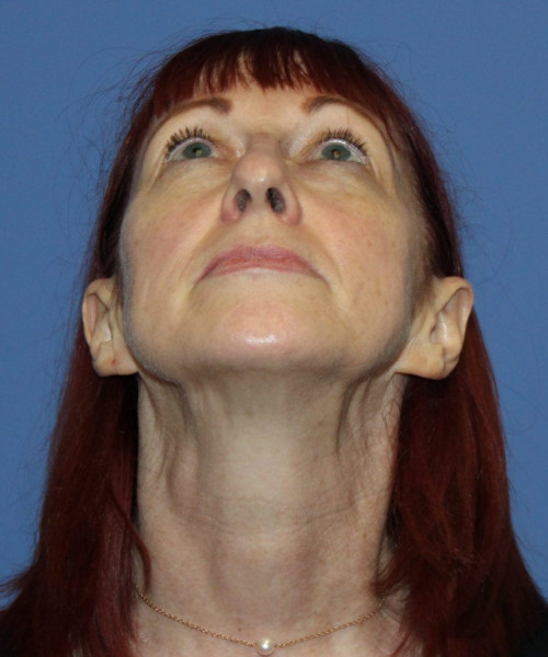Facelift #5986 – click HERE for more views before photo. Individual results may vary.