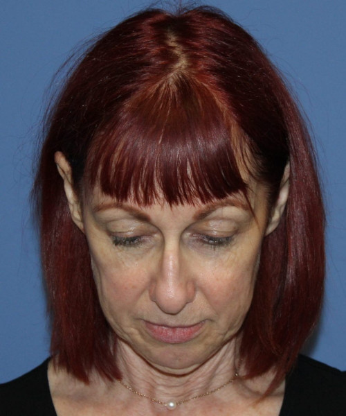 Facelift #5986 – click HERE for more views before photo. Individual results may vary.