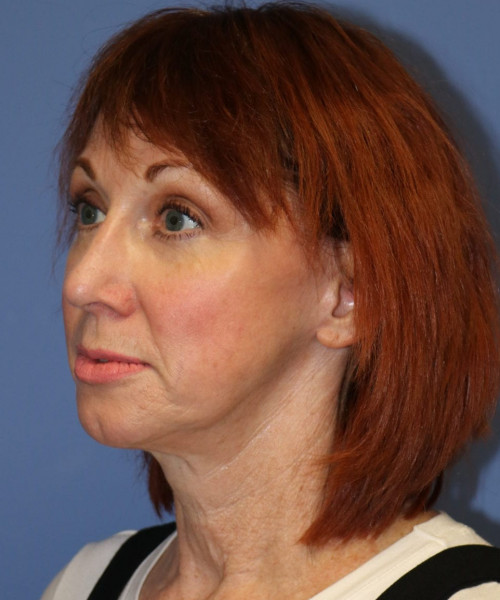 Facelift #5986 – click HERE for more views after photo. Individual results may vary.