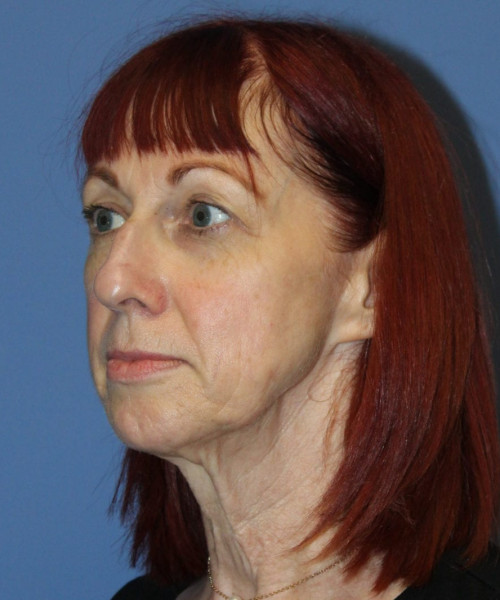 Facelift #5986 – click HERE for more views before photo. Individual results may vary.