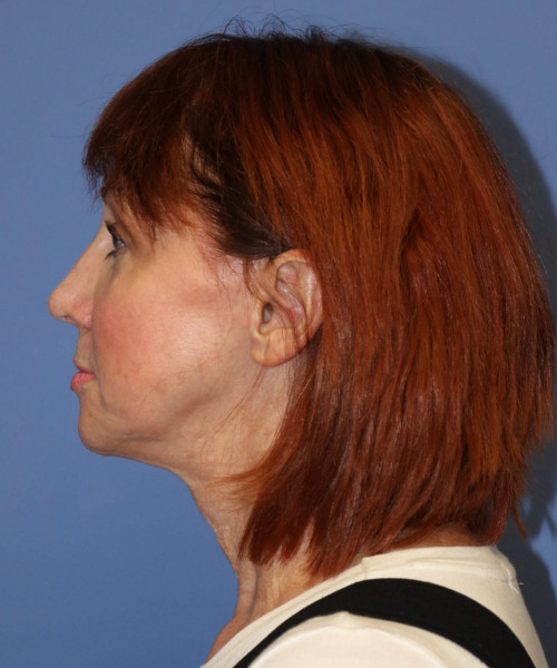 Facelift #5986 – click HERE for more views after photo. Individual results may vary.