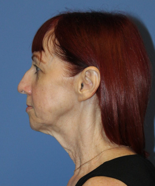 Facelift #5986 – click HERE for more views before photo. Individual results may vary.