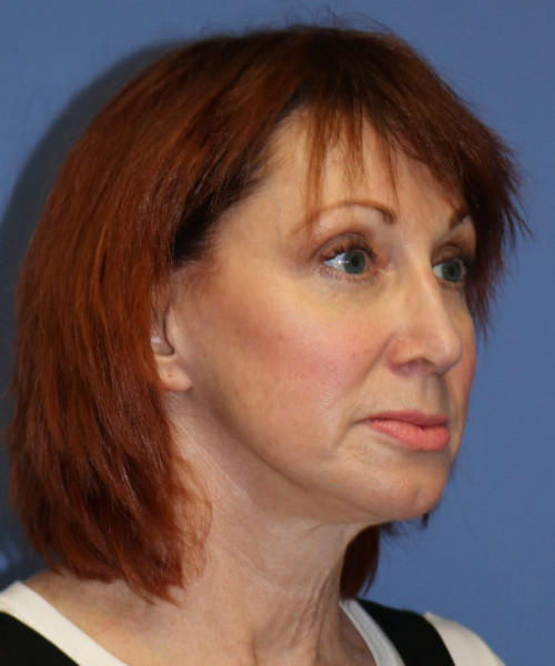 Facelift #5986 – click HERE for more views after photo. Individual results may vary.