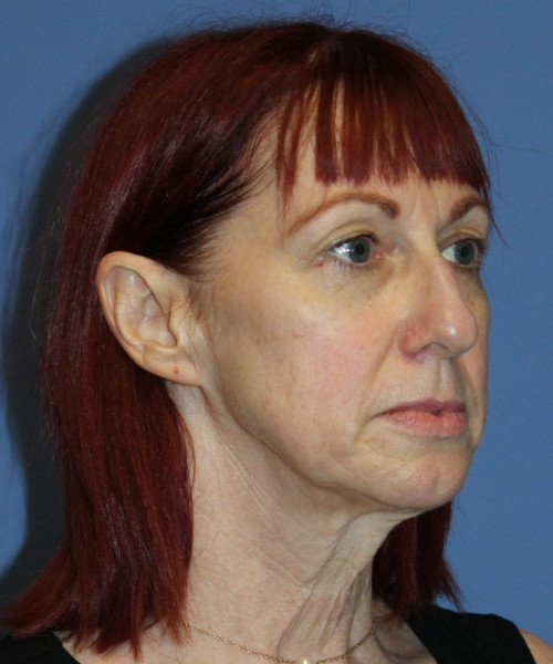 Facelift #5986 – click HERE for more views before photo. Individual results may vary.