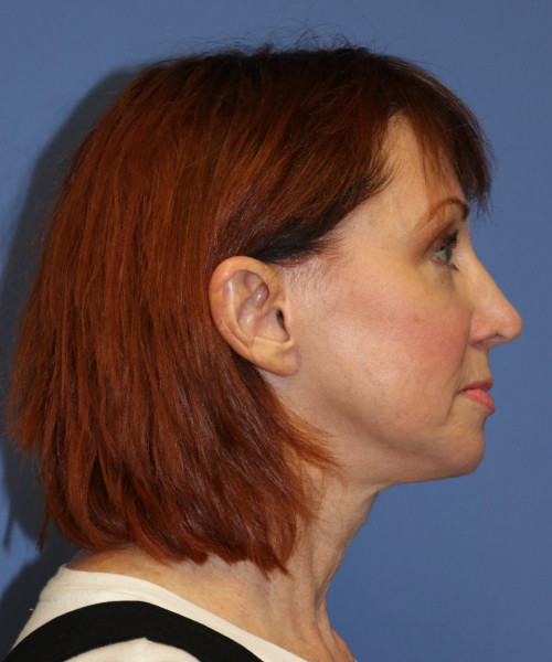 Facelift #5986 – click HERE for more views after photo. Individual results may vary.