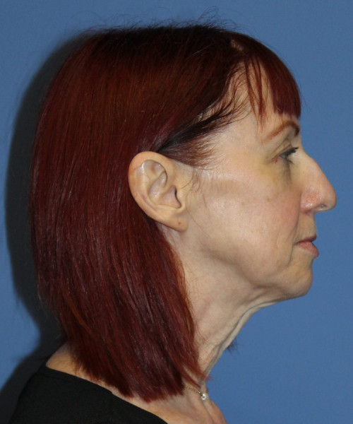 Facelift #5986 – click HERE for more views before photo. Individual results may vary.