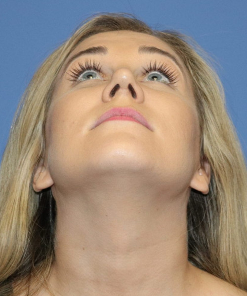 Rhinoplasty #6027 – click HERE for more views after photo. Individual results may vary.