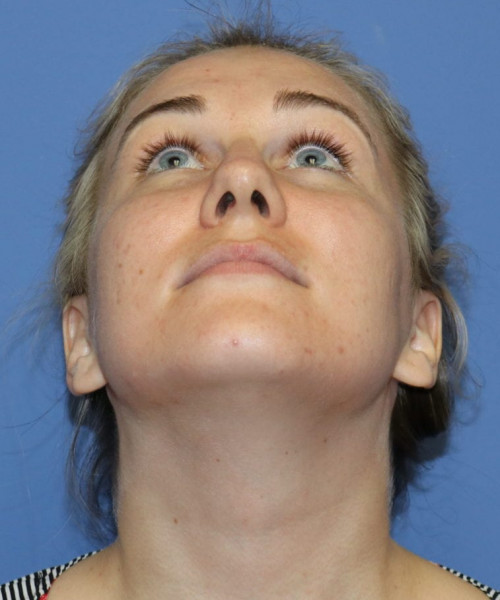 Rhinoplasty #6027 – click HERE for more views before photo. Individual results may vary.
