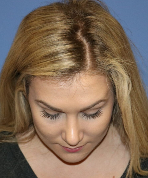 Rhinoplasty #6027 – click HERE for more views after photo. Individual results may vary.