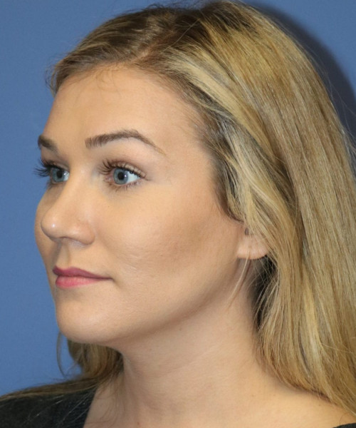 Rhinoplasty #6027 – click HERE for more views after photo. Individual results may vary.