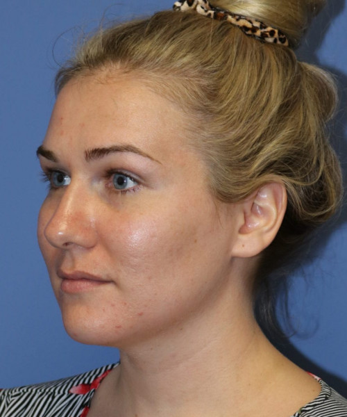 Rhinoplasty #6027 – click HERE for more views before photo. Individual results may vary.