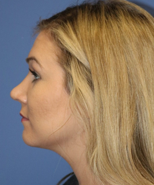 Rhinoplasty #6027 – click HERE for more views after photo. Individual results may vary.