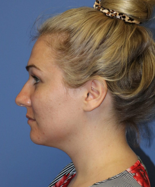 Rhinoplasty #6027 – click HERE for more views before photo. Individual results may vary.