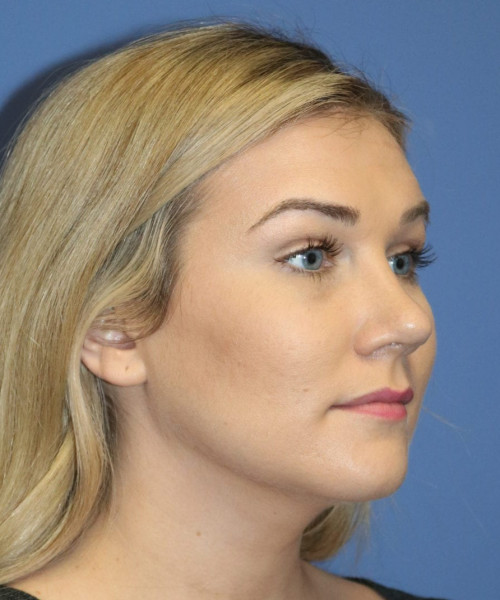 Rhinoplasty #6027 – click HERE for more views after photo. Individual results may vary.