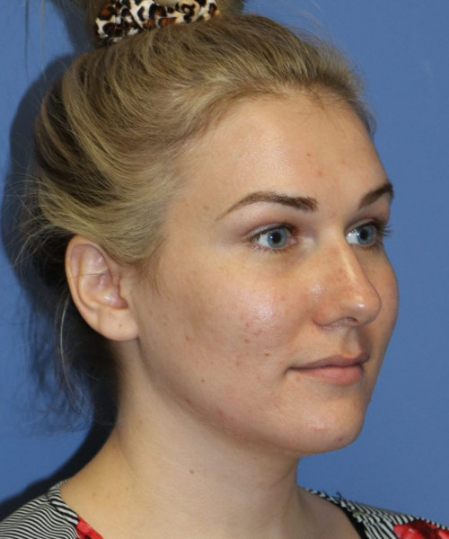 Rhinoplasty #6027 – click HERE for more views before photo. Individual results may vary.