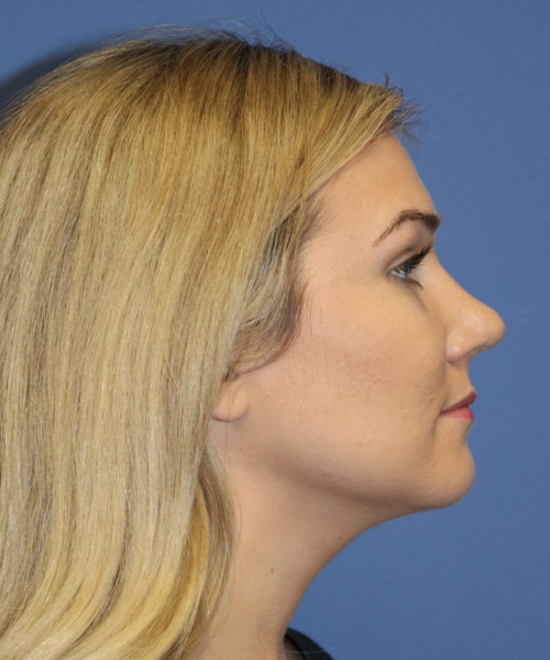 Rhinoplasty #6027 – click HERE for more views after photo. Individual results may vary.