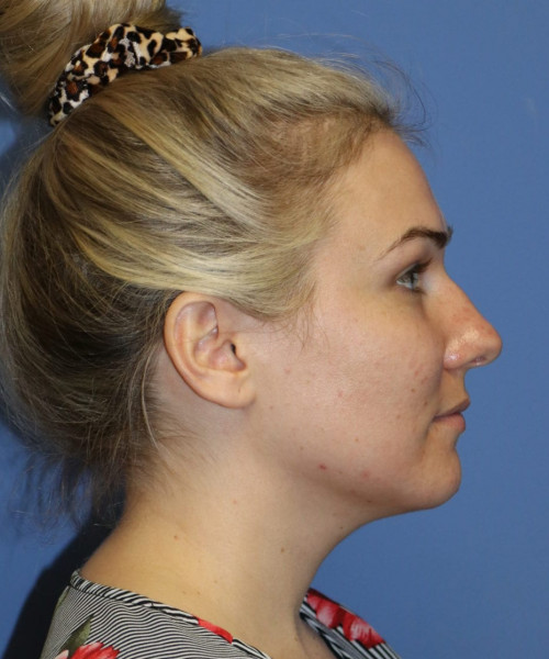 Rhinoplasty #6027 – click HERE for more views before photo. Individual results may vary.