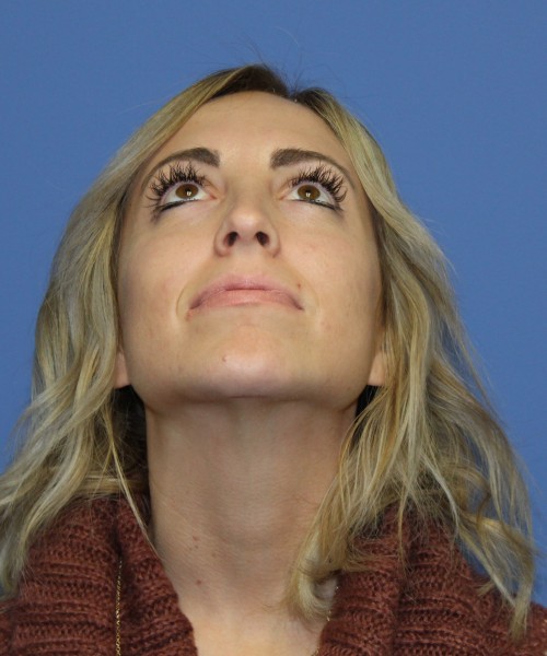 Rhinoplasty, Chin Augmentation 0604 – Click HERE for more after photo. Individual results may vary.
