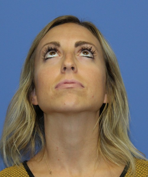 Rhinoplasty, Chin Augmentation 0604 – Click HERE for more before photo. Individual results may vary.