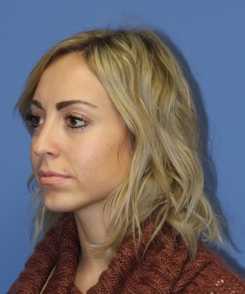 Rhinoplasty, Chin Augmentation 0604 – Click HERE for more after photo. Individual results may vary.