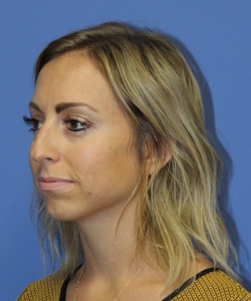 Rhinoplasty, Chin Augmentation 0604 – Click HERE for more before photo. Individual results may vary.