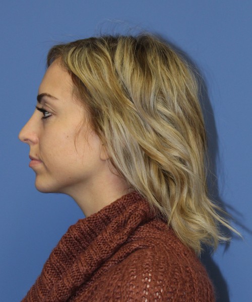 Rhinoplasty, Chin Augmentation 0604 – Click HERE for more after photo. Individual results may vary.