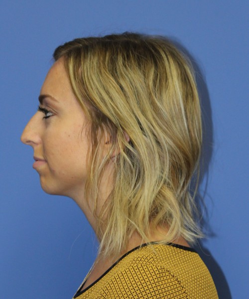 Rhinoplasty, Chin Augmentation 0604 – Click HERE for more before photo. Individual results may vary.