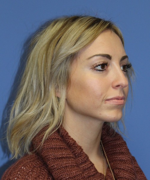 Rhinoplasty, Chin Augmentation 0604 – Click HERE for more after photo. Individual results may vary.