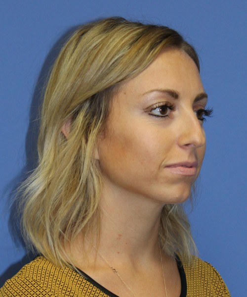 Rhinoplasty, Chin Augmentation 0604 – Click HERE for more before photo. Individual results may vary.