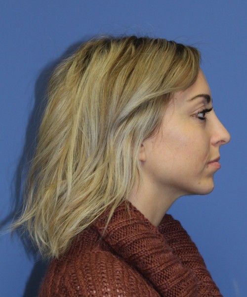 Rhinoplasty, Chin Augmentation 0604 – Click HERE for more after photo. Individual results may vary.