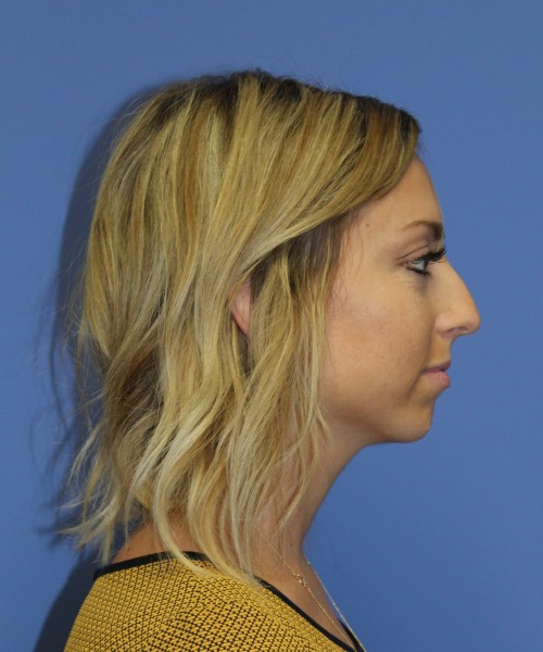 Rhinoplasty, Chin Augmentation 0604 – Click HERE for more before photo. Individual results may vary.