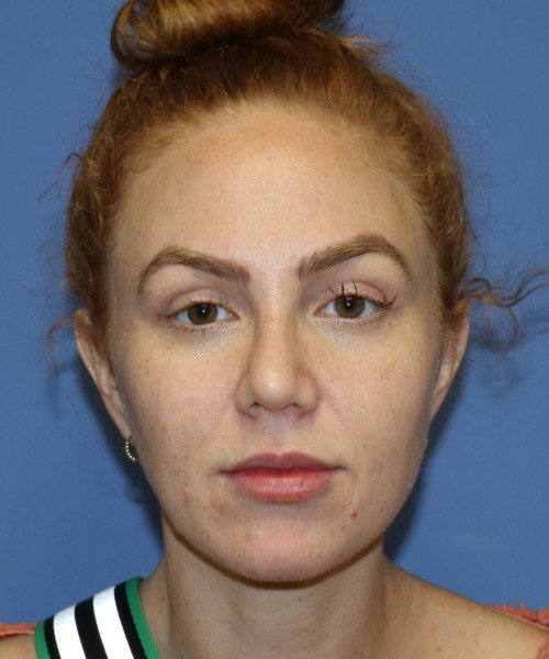 Rhinoplasty #6042 – click HERE for more views after photo. Individual results may vary.
