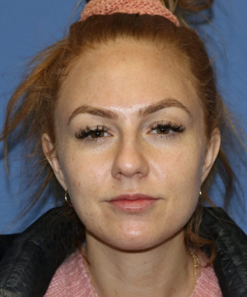 Rhinoplasty #6042 – click HERE for more views before photo. Individual results may vary.