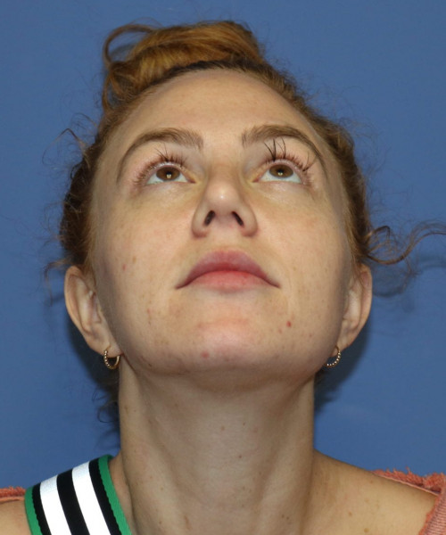 Rhinoplasty #6042 – click HERE for more views after photo. Individual results may vary.