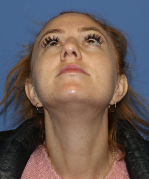 Rhinoplasty #6042 – click HERE for more views before photo. Individual results may vary.
