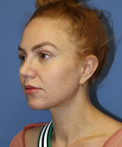 Rhinoplasty #6042 – click HERE for more views after photo. Individual results may vary.