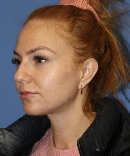Rhinoplasty #6042 – click HERE for more views before photo. Individual results may vary.