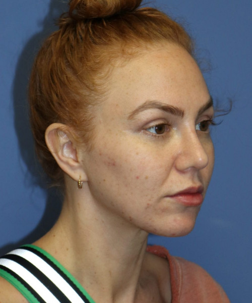 Rhinoplasty #6042 – click HERE for more views after photo. Individual results may vary.