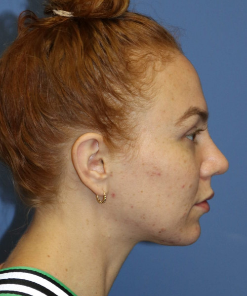 Rhinoplasty #6042 – click HERE for more views after photo. Individual results may vary.
