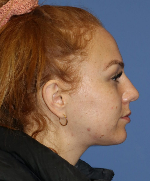 Rhinoplasty #6042 – click HERE for more views before photo. Individual results may vary.