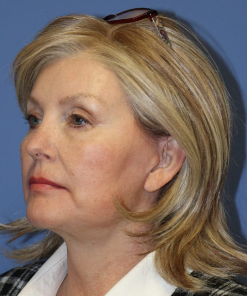 Facelift #6068 – click HERE for more views after photo. Individual results may vary.