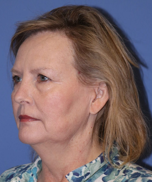 Facelift #6068 – click HERE for more views before photo. Individual results may vary.